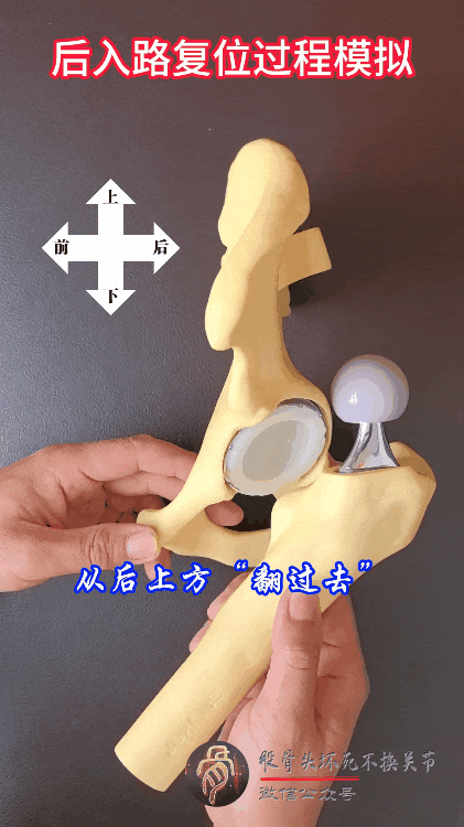 髋臼骨折4块板15颗钉，关节怎么换？