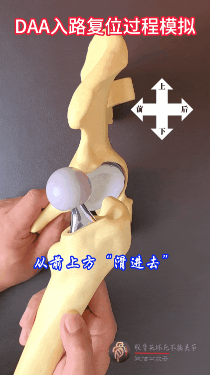 34张图文详解：21年融合髋THA的几点体会