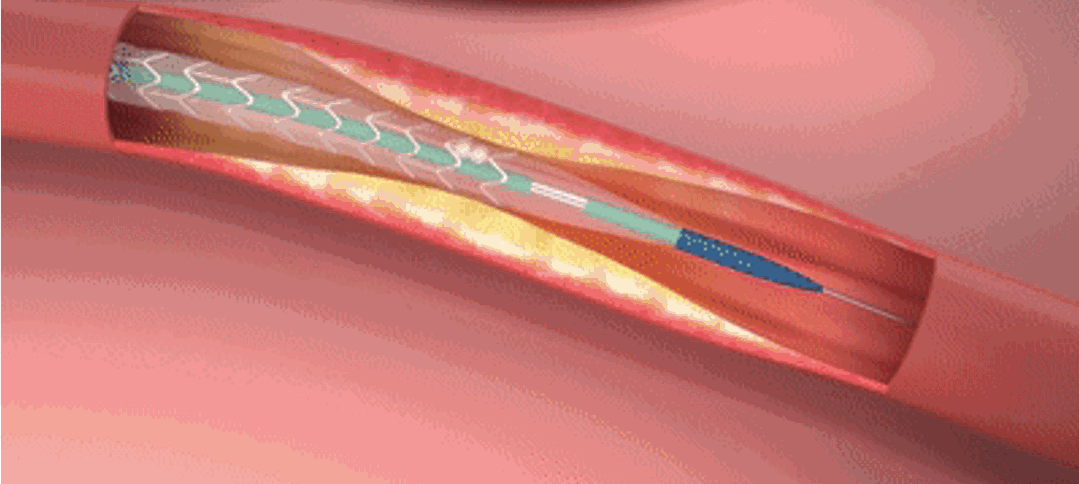 心血管支架移植模拟分析（ANSYS_APDL命令流）的图1