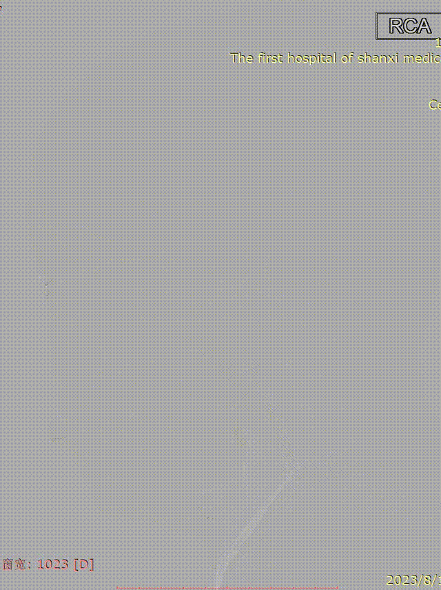 波科支架怎么样径技-弓上病例大赏｜第210期·右侧颈内动脉球囊扩张术+支架植入术_https://www.jmylbn.com_新闻资讯_第23张