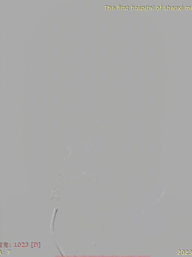 波科支架怎么样径技-弓上病例大赏｜第210期·右侧颈内动脉球囊扩张术+支架植入术_https://www.jmylbn.com_新闻资讯_第22张