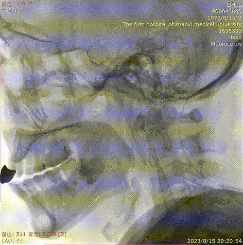 波科支架怎么样径技-弓上病例大赏｜第210期·右侧颈内动脉球囊扩张术+支架植入术_https://www.jmylbn.com_新闻资讯_第19张