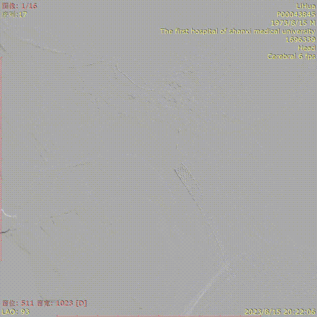 波科支架怎么样径技-弓上病例大赏｜第210期·右侧颈内动脉球囊扩张术+支架植入术_https://www.jmylbn.com_新闻资讯_第20张
