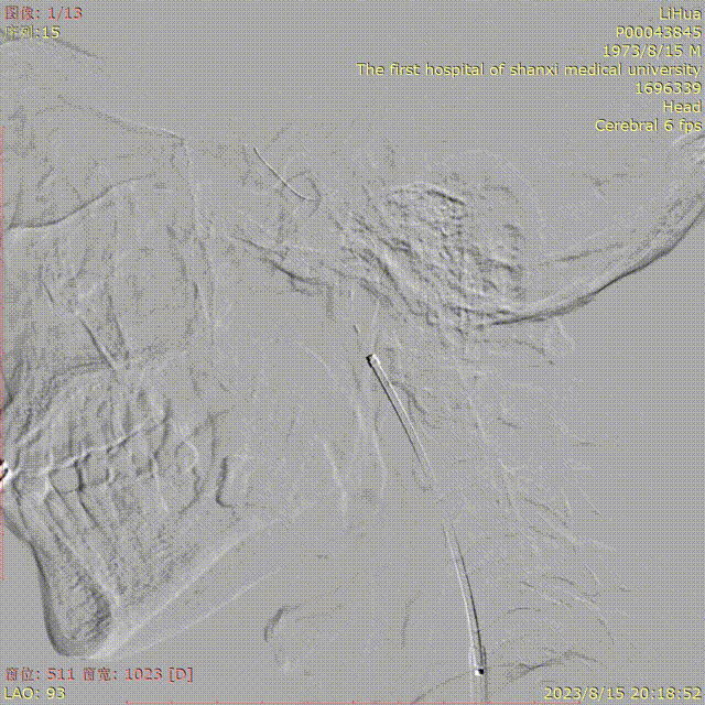 波科支架怎么样径技-弓上病例大赏｜第210期·右侧颈内动脉球囊扩张术+支架植入术_https://www.jmylbn.com_新闻资讯_第18张
