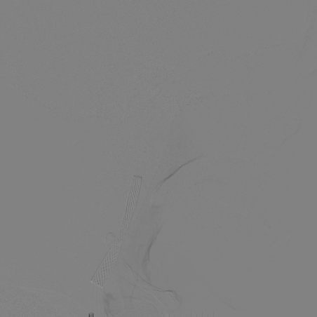 波科支架怎么样​径技·第165期｜7F经桡入路下的颈动脉狭窄支架成形术一例_https://www.jmylbn.com_新闻资讯_第34张