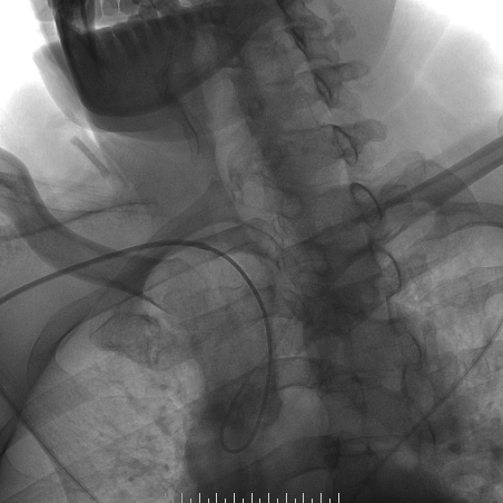 波科支架怎么样​径技·第165期｜7F经桡入路下的颈动脉狭窄支架成形术一例_https://www.jmylbn.com_新闻资讯_第22张