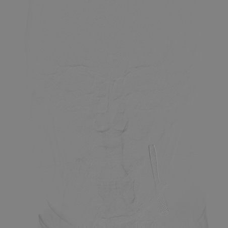 波科支架怎么样​径技·第165期｜7F经桡入路下的颈动脉狭窄支架成形术一例_https://www.jmylbn.com_新闻资讯_第32张