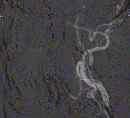 波科支架怎么样​径技·第165期｜7F经桡入路下的颈动脉狭窄支架成形术一例_https://www.jmylbn.com_新闻资讯_第25张