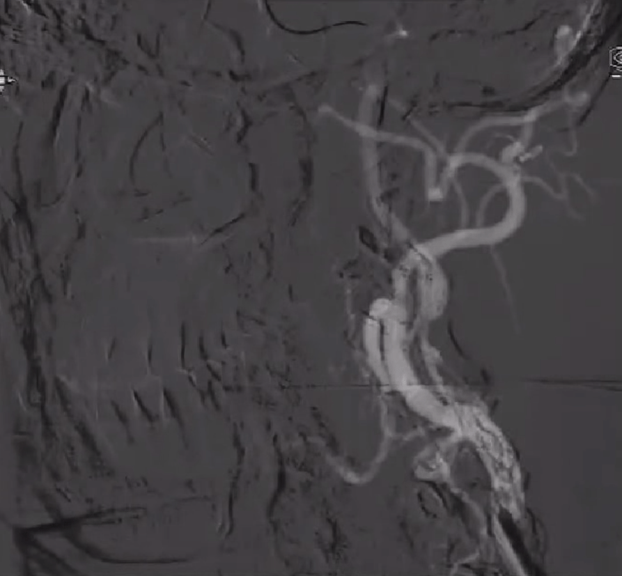 波科支架怎么样​径技·第165期｜7F经桡入路下的颈动脉狭窄支架成形术一例_https://www.jmylbn.com_新闻资讯_第26张