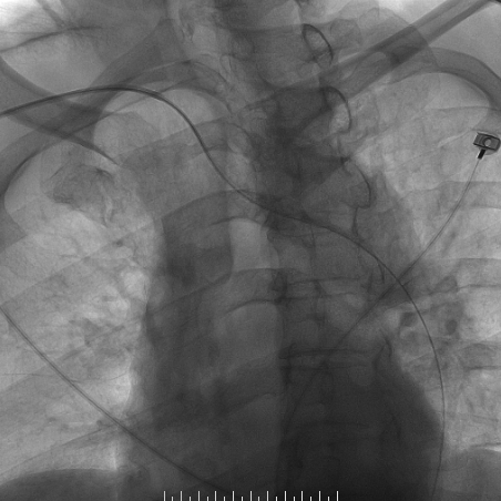 波科支架怎么样​径技·第165期｜7F经桡入路下的颈动脉狭窄支架成形术一例_https://www.jmylbn.com_新闻资讯_第21张
