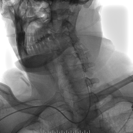 波科支架怎么样​径技·第165期｜7F经桡入路下的颈动脉狭窄支架成形术一例_https://www.jmylbn.com_新闻资讯_第23张