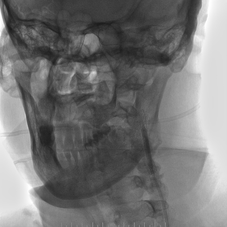 波科支架怎么样​径技·第165期｜7F经桡入路下的颈动脉狭窄支架成形术一例_https://www.jmylbn.com_新闻资讯_第30张