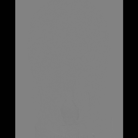 波科支架怎么样​径技·第165期｜7F经桡入路下的颈动脉狭窄支架成形术一例_https://www.jmylbn.com_新闻资讯_第33张