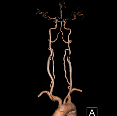波科支架怎么样​径技·第165期｜7F经桡入路下的颈动脉狭窄支架成形术一例_https://www.jmylbn.com_新闻资讯_第3张