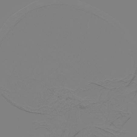 波科支架怎么样​径技·第165期｜7F经桡入路下的颈动脉狭窄支架成形术一例_https://www.jmylbn.com_新闻资讯_第35张