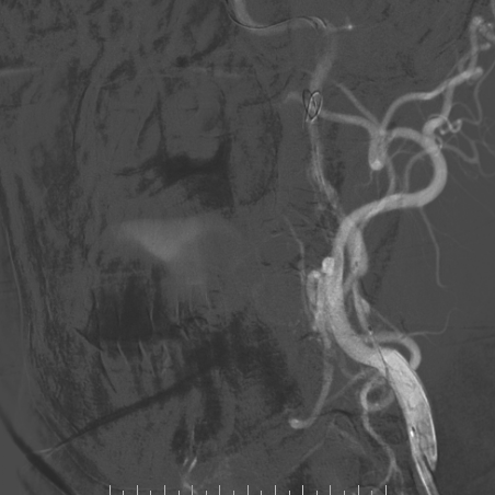 波科支架怎么样​径技·第165期｜7F经桡入路下的颈动脉狭窄支架成形术一例_https://www.jmylbn.com_新闻资讯_第27张