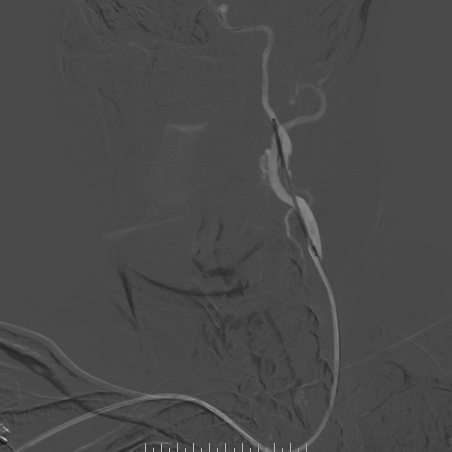 波科支架怎么样​径技·第165期｜7F经桡入路下的颈动脉狭窄支架成形术一例_https://www.jmylbn.com_新闻资讯_第29张
