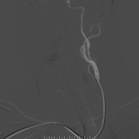 波科支架怎么样​径技·第165期｜7F经桡入路下的颈动脉狭窄支架成形术一例_https://www.jmylbn.com_新闻资讯_第28张