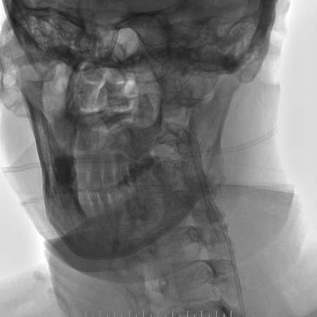 波科支架怎么样​径技·第165期｜7F经桡入路下的颈动脉狭窄支架成形术一例_https://www.jmylbn.com_新闻资讯_第31张