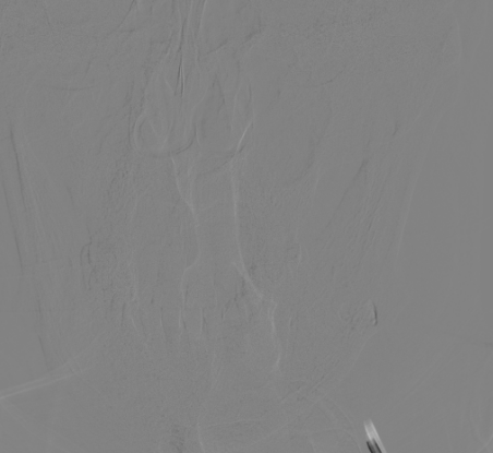 波科支架怎么样​径技·第165期｜7F经桡入路下的颈动脉狭窄支架成形术一例_https://www.jmylbn.com_新闻资讯_第24张