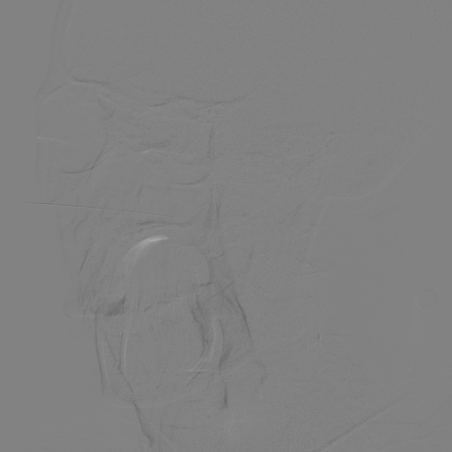 波科支架怎么样​径技·第165期｜7F经桡入路下的颈动脉狭窄支架成形术一例_https://www.jmylbn.com_新闻资讯_第11张