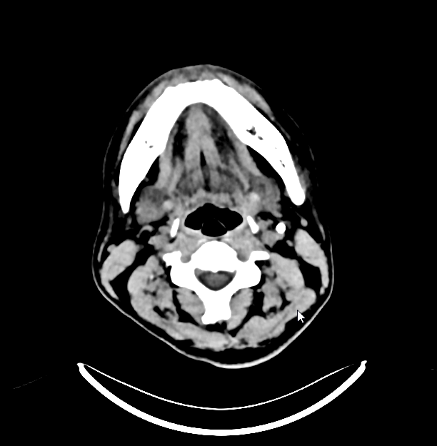 血栓泵是什么健谈卒中｜ACE抽吸导管配合专用抽吸泵治疗颅内静脉窦高负荷量血栓一例_https://www.jmylbn.com_新闻资讯_第12张