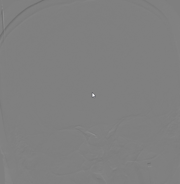 血栓泵是什么健谈卒中｜ACE抽吸导管配合专用抽吸泵治疗颅内静脉窦高负荷量血栓一例_https://www.jmylbn.com_新闻资讯_第13张