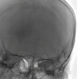 血栓泵是什么健谈卒中｜ACE抽吸导管配合专用抽吸泵治疗颅内静脉窦高负荷量血栓一例_https://www.jmylbn.com_新闻资讯_第9张