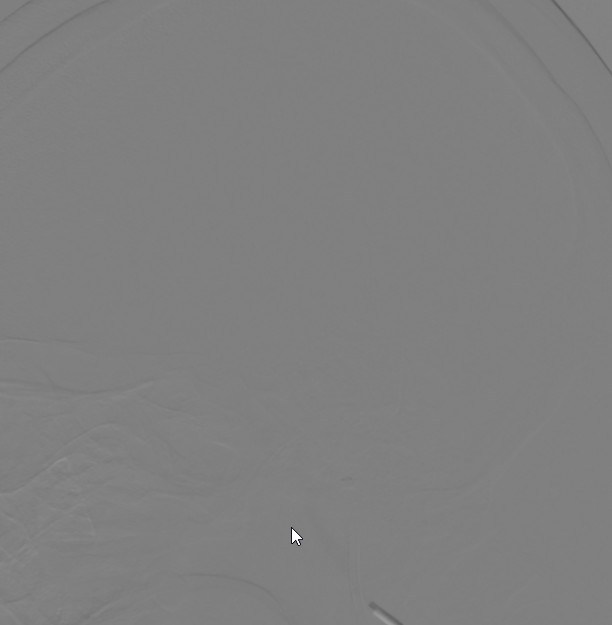 血栓泵是什么健谈卒中｜ACE抽吸导管配合专用抽吸泵治疗颅内静脉窦高负荷量血栓一例_https://www.jmylbn.com_新闻资讯_第14张