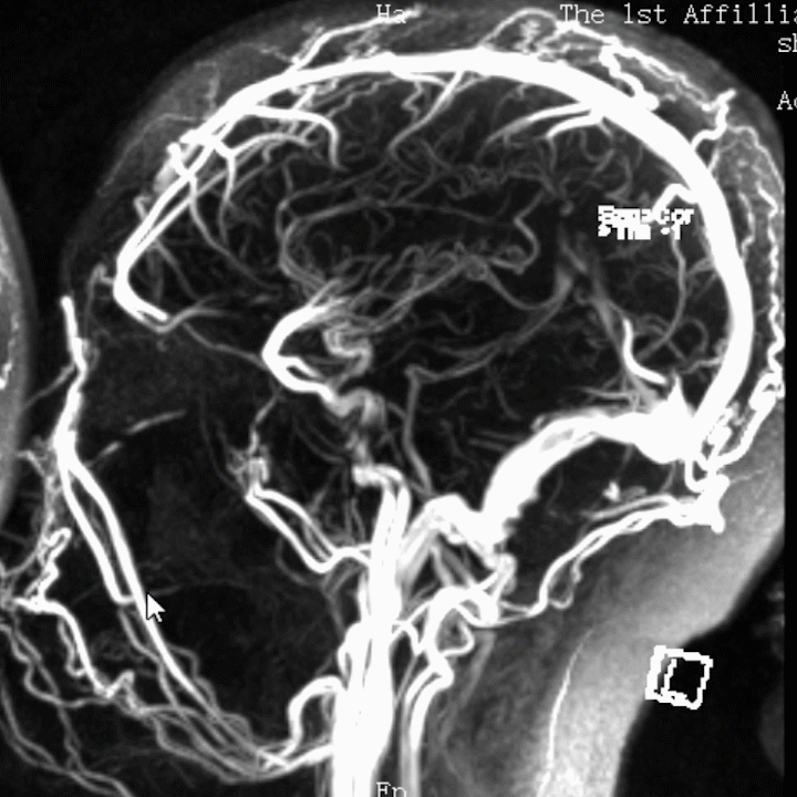血栓泵是什么健谈卒中｜ACE抽吸导管配合专用抽吸泵治疗颅内静脉窦高负荷量血栓一例_https://www.jmylbn.com_新闻资讯_第15张