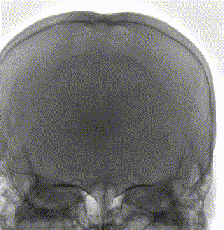 血栓泵是什么健谈卒中｜ACE抽吸导管配合专用抽吸泵治疗颅内静脉窦高负荷量血栓一例_https://www.jmylbn.com_新闻资讯_第8张