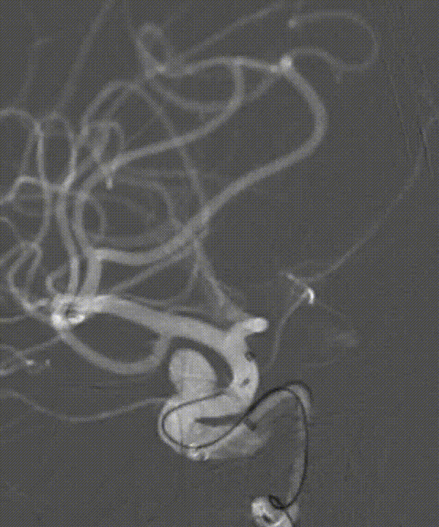 动脉长鞘怎么置入深谋远路 ｜ 千人皆翘首，万唤今始来——国内首款7F长鞘在血流导向密网支架联合弹簧圈栓塞治疗动脉瘤的首次应用_https://www.jmylbn.com_新闻资讯_第25张