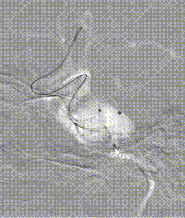 动脉长鞘怎么置入深谋远路 ｜ 千人皆翘首，万唤今始来——国内首款7F长鞘在血流导向密网支架联合弹簧圈栓塞治疗动脉瘤的首次应用_https://www.jmylbn.com_新闻资讯_第8张