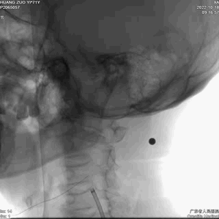 动脉长鞘怎么置入【康德莱医械】经桡介入LA长鞘+Sim II通路组合处理颈内动脉狭窄_https://www.jmylbn.com_新闻资讯_第17张