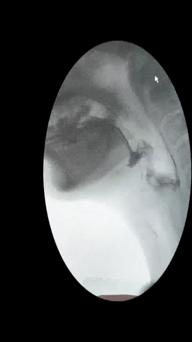 为什么要做吞咽仪器【康复加油站】吞咽障碍康复：打破“进食困境”，重享生活滋味_https://www.jmylbn.com_新闻资讯_第4张