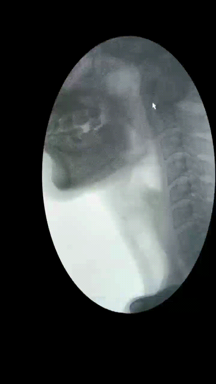 为什么要做吞咽仪器【康复加油站】吞咽障碍康复：打破“进食困境”，重享生活滋味_https://www.jmylbn.com_新闻资讯_第3张