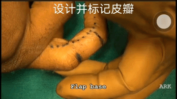 指端缺损治疗系列–临指皮瓣（视频动画）