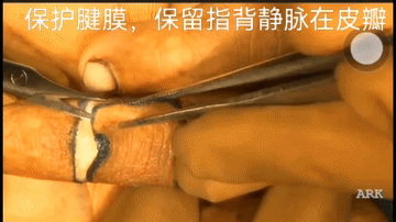 指端缺损治疗系列–临指皮瓣（视频动画）