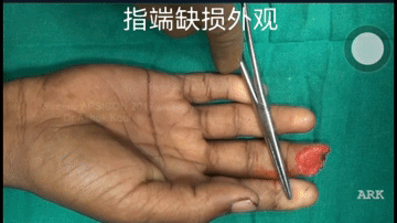 指端缺损治疗系列–临指皮瓣（视频动画）