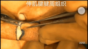 指端缺损治疗系列–临指皮瓣（视频动画）