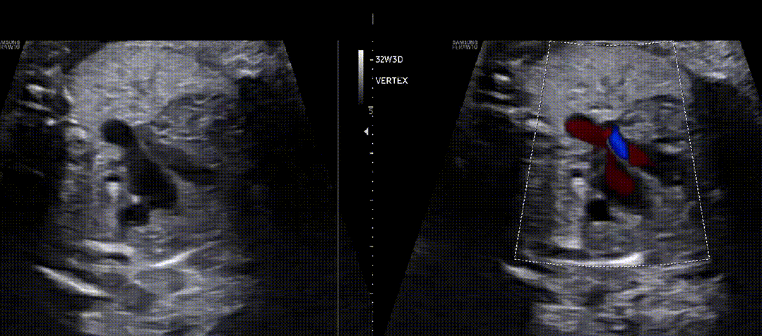 胎儿mt是什么检查什么疼吗ASE胎儿超声心动图检查指南及建议（更新）IV. 针对特定疾病的解剖、生理和功能胎儿超声心动图评估指南-C.结构性心脏病-iv_https://www.jmylbn.com_新闻资讯_第10张