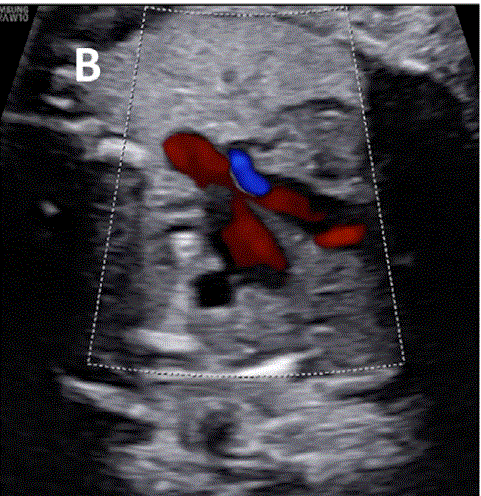 胎儿mt是什么检查什么疼吗ASE胎儿超声心动图检查指南及建议（更新）IV. 针对特定疾病的解剖、生理和功能胎儿超声心动图评估指南-C.结构性心脏病-iv_https://www.jmylbn.com_新闻资讯_第7张