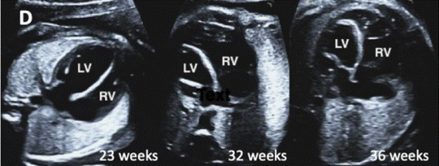 胎儿mt是什么检查什么疼吗ASE胎儿超声心动图检查指南及建议（更新）IV. 针对特定疾病的解剖、生理和功能胎儿超声心动图评估指南-C.结构性心脏病-iv_https://www.jmylbn.com_新闻资讯_第5张