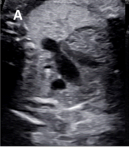 胎儿mt是什么检查什么疼吗ASE胎儿超声心动图检查指南及建议（更新）IV. 针对特定疾病的解剖、生理和功能胎儿超声心动图评估指南-C.结构性心脏病-iv_https://www.jmylbn.com_新闻资讯_第6张