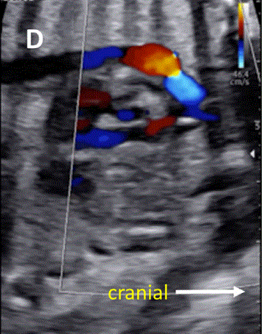 胎儿mt是什么检查什么疼吗ASE胎儿超声心动图检查指南及建议（更新）IV. 针对特定疾病的解剖、生理和功能胎儿超声心动图评估指南-C.结构性心脏病-iv_https://www.jmylbn.com_新闻资讯_第9张