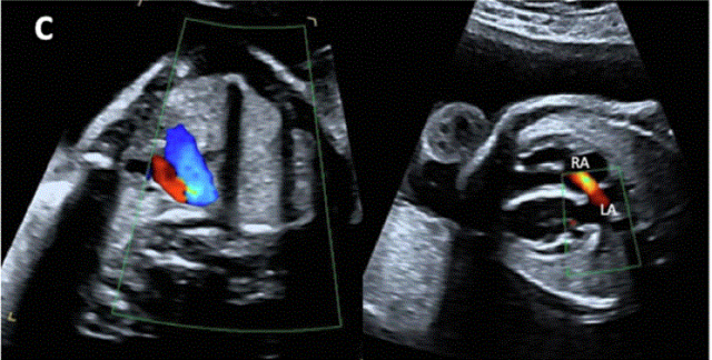 胎儿mt是什么检查什么疼吗ASE胎儿超声心动图检查指南及建议（更新）IV. 针对特定疾病的解剖、生理和功能胎儿超声心动图评估指南-C.结构性心脏病-iv_https://www.jmylbn.com_新闻资讯_第4张