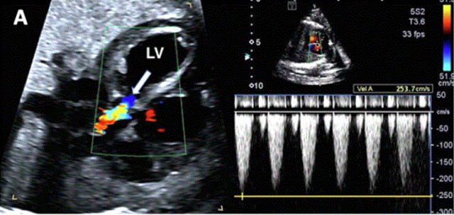 胎儿mt是什么检查什么疼吗ASE胎儿超声心动图检查指南及建议（更新）IV. 针对特定疾病的解剖、生理和功能胎儿超声心动图评估指南-C.结构性心脏病-iv_https://www.jmylbn.com_新闻资讯_第2张