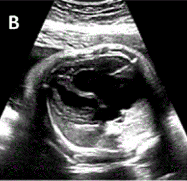 胎儿mt是什么检查什么疼吗ASE胎儿超声心动图检查指南及建议（更新）IV. 针对特定疾病的解剖、生理和功能胎儿超声心动图评估指南-C.结构性心脏病-iv_https://www.jmylbn.com_新闻资讯_第12张