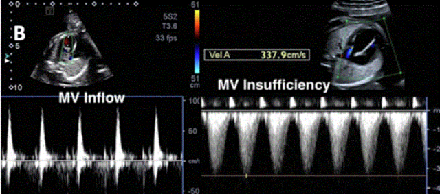 胎儿mt是什么检查什么疼吗ASE胎儿超声心动图检查指南及建议（更新）IV. 针对特定疾病的解剖、生理和功能胎儿超声心动图评估指南-C.结构性心脏病-iv_https://www.jmylbn.com_新闻资讯_第3张