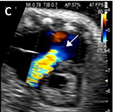 胎儿mt是什么检查什么疼吗ASE胎儿超声心动图检查指南及建议（更新）IV. 针对特定疾病的解剖、生理和功能胎儿超声心动图评估指南-C.结构性心脏病-iv_https://www.jmylbn.com_新闻资讯_第13张